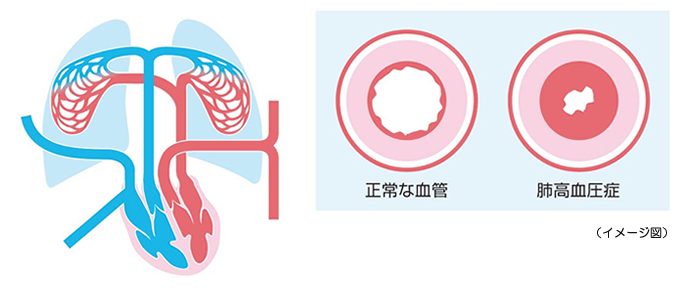 肺 高血圧 症